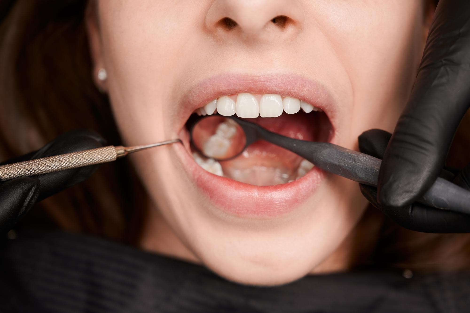 Inlays or Fillings: What Dentists Look At Before Deciding
