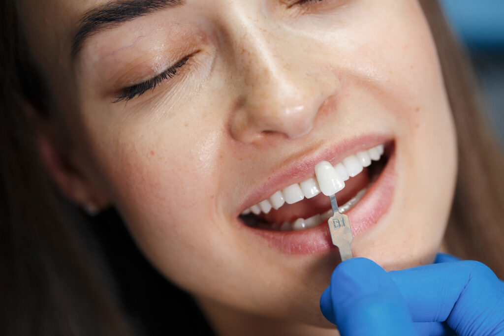 veneers in riverpark
