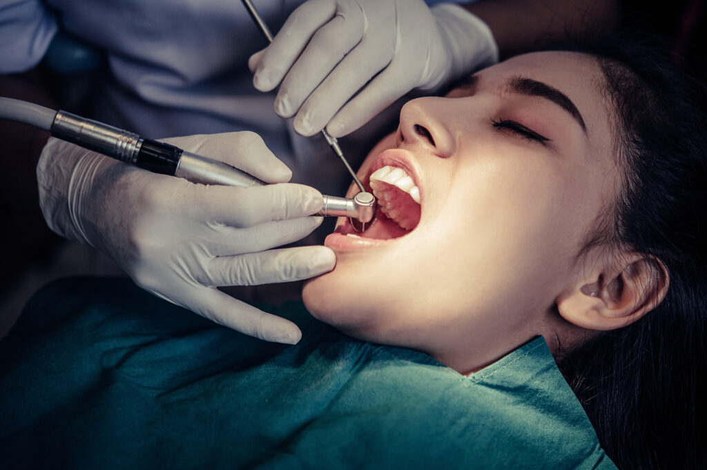 Dental Fillings