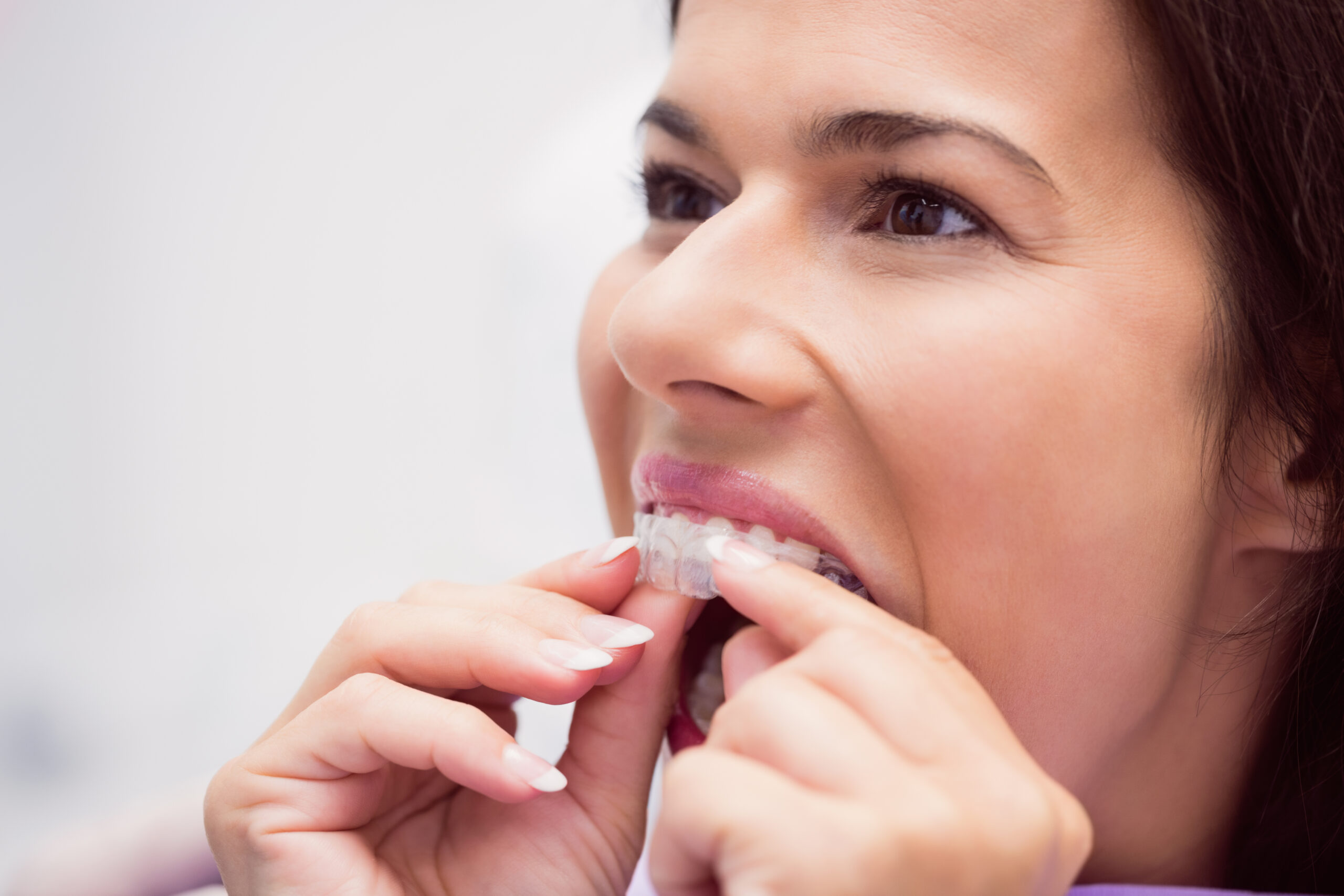 invisalign dentist in riverpark