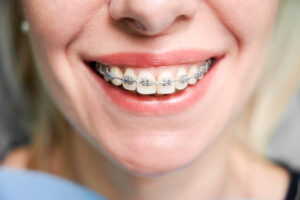 Teeth braces near me