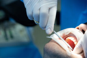 tooth extraction in Riverpark