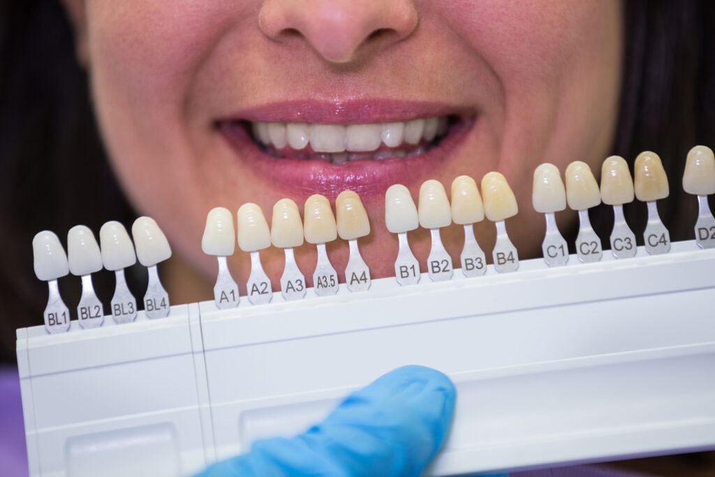 porcelain veneers in Riverpark