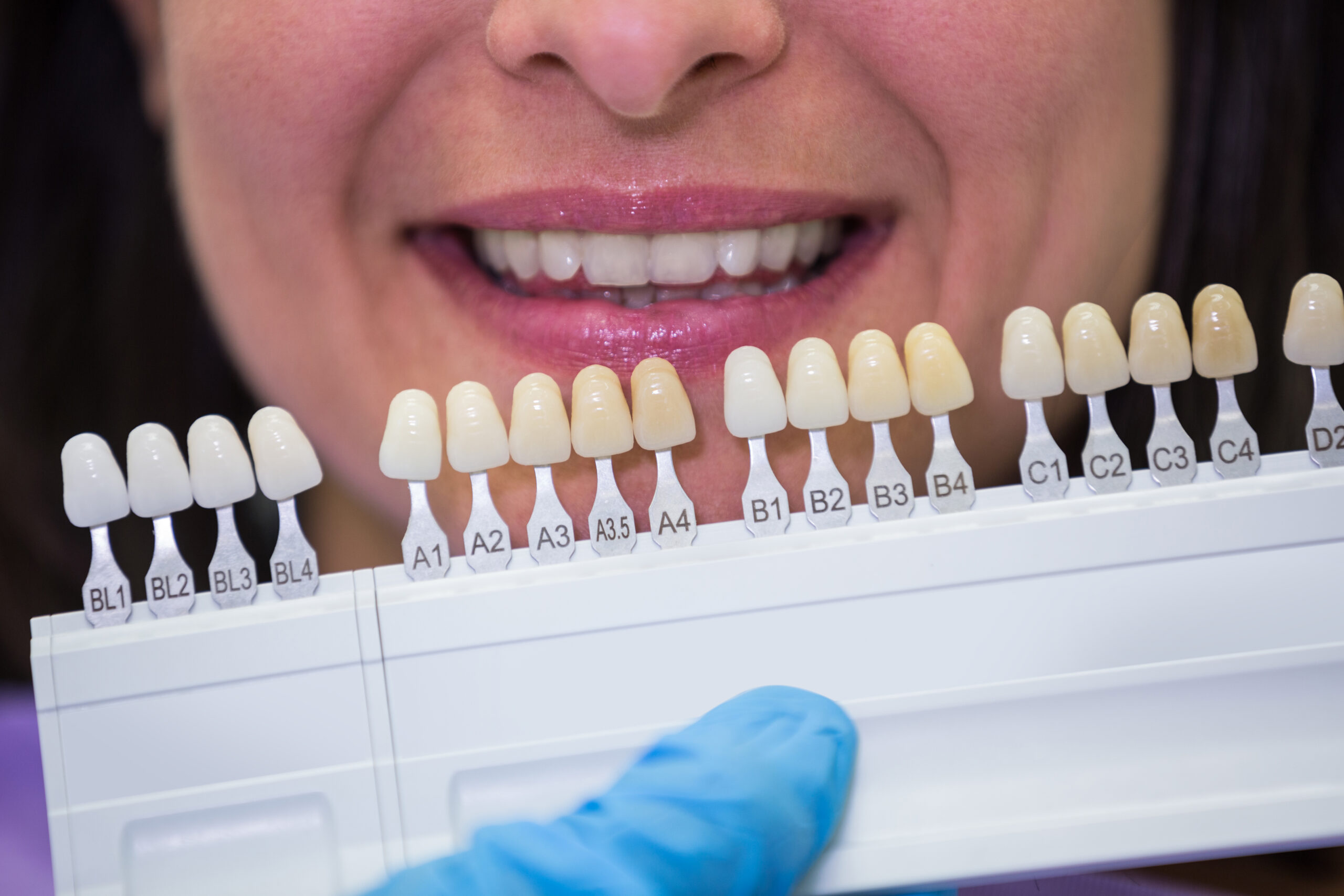 porcelain veneers in Riverpark