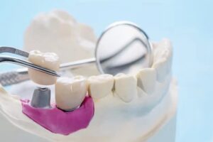 dental crowns in Riverpark