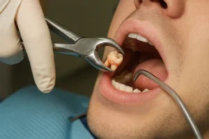 Tooth Extracted