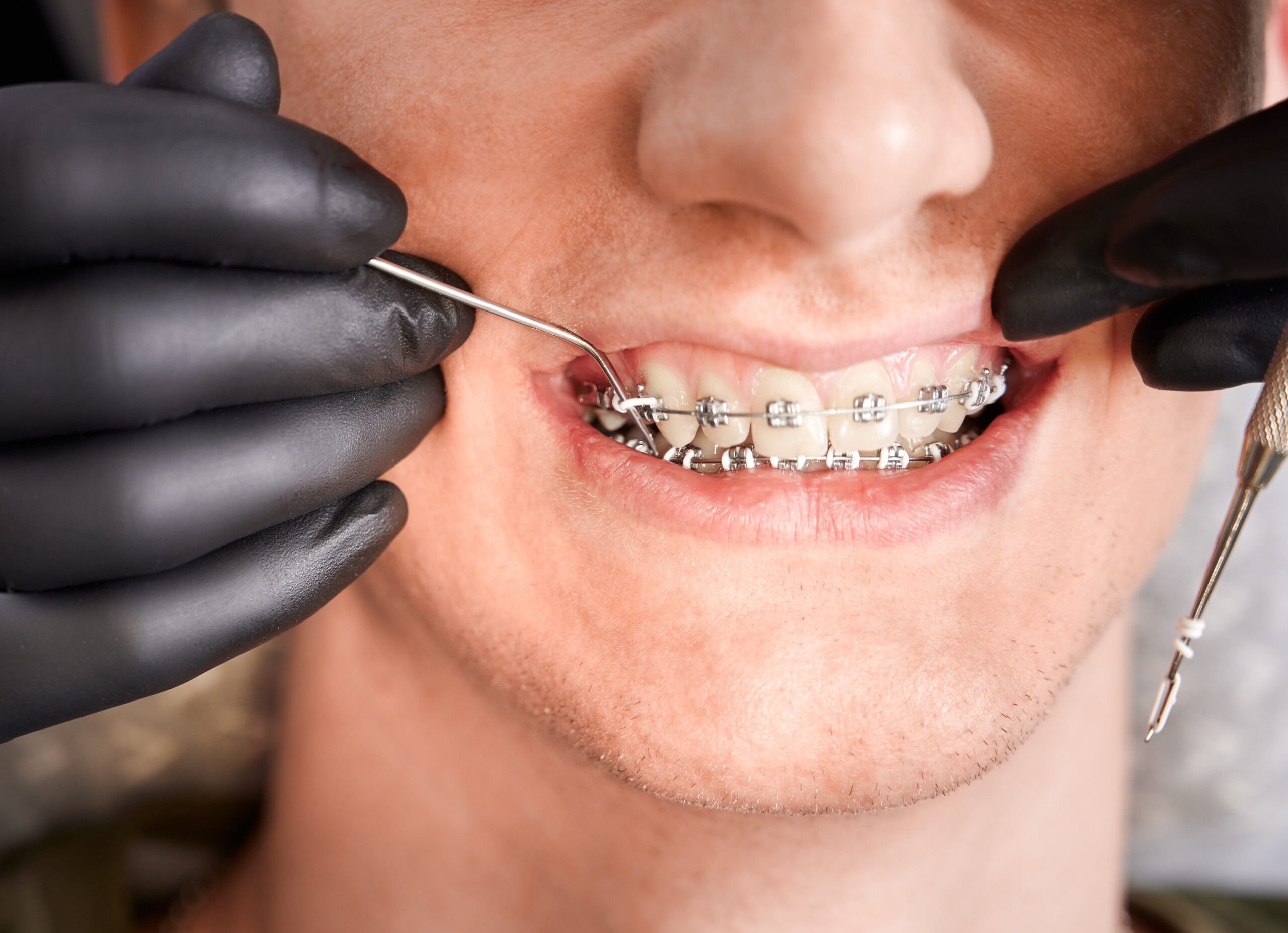 metal braces