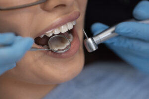 dental fillings