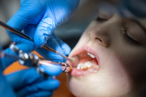 Tooth Extraction